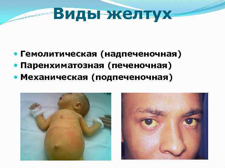 Виды желтух Гемолитическая (надпеченочная) Паренхиматозная (печеночная) Механическая (подпеченочная) 