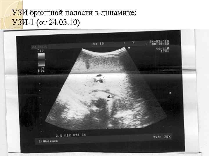 УЗИ брюшной полости в динамике: УЗИ-1 (от 24. 03. 10) 