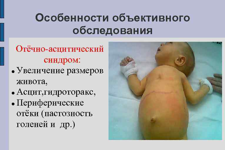 Особенности объективного обследования Отёчно-асцитический синдром: Увеличение размеров живота, Асцит, гидроторакс, Периферические отёки (пастозность голеней