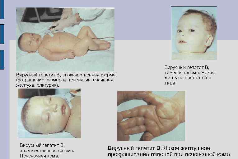 Вирусный гепатит В, злокачественная форма (сокращение размеров печени, интенсивная желтуха, олигурия). Вирусный гепатит В,