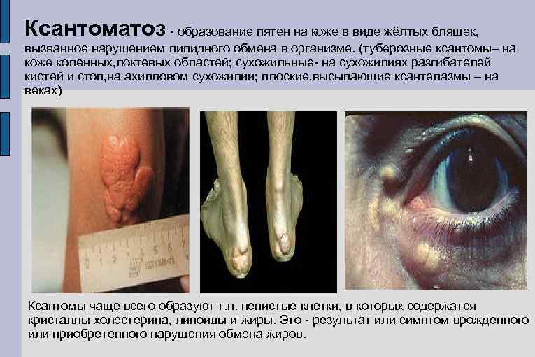 Ксантоматоз - образование пятен на коже в виде жёлтых бляшек, вызванное нарушением липидного обмена