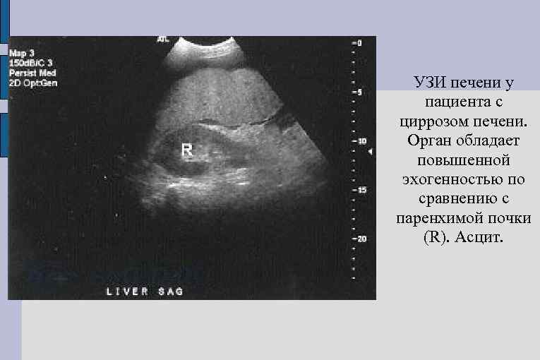 УЗИ печени у пациента с циррозом печени. Орган обладает повышенной эхогенностью по сравнению с