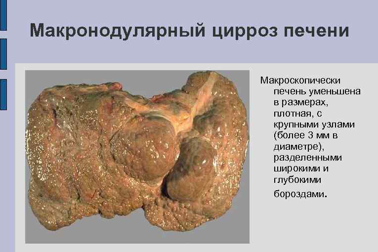 Макронодулярный цирроз печени Макроскопически печень уменьшена в размерах, плотная, с крупными узлами (более 3