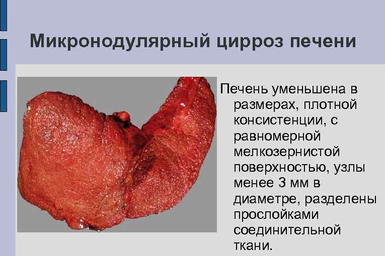 Микронодулярный цирроз печени Печень уменьшена в размерах, плотной консистенции, с равномерной мелкозернистой поверхностью, узлы