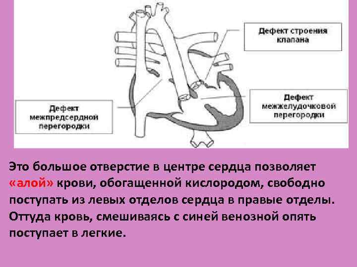 Это большое отверстие в центре сердца позволяет «алой» крови, обогащенной кислородом, свободно поступать из