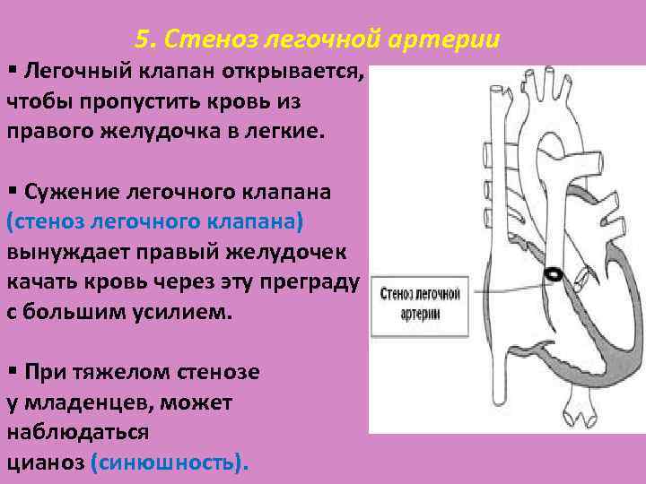 Какой цифрой на рисунке обозначен клапан между правым желудочком и легочной артерией