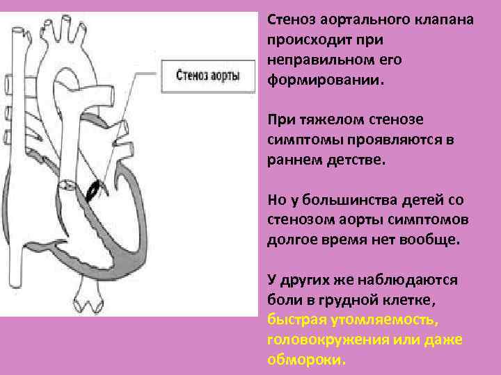 Стеноз что это. Врожденный стеноз устья аорты. Стеноз аортального клапана у детей. Клапанный аортальный стеноз симптомы.