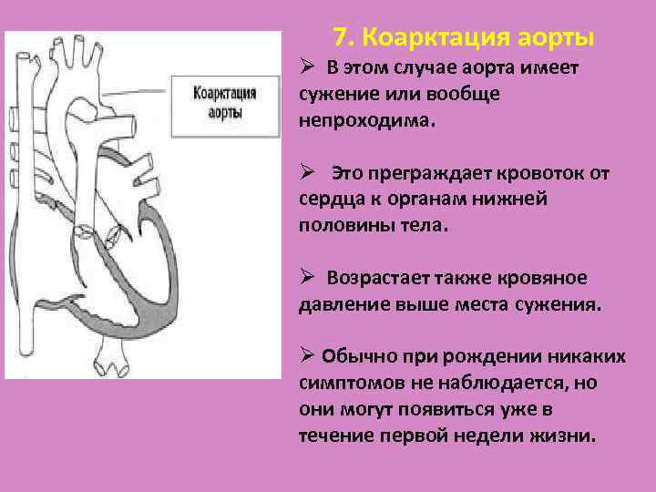 Аортальный градиент. Схема коарктации аорты. Коарктация аорты у детей клинические. Постдуктальная коарктация аорты. Юкстадуктальная коарктация аорты.