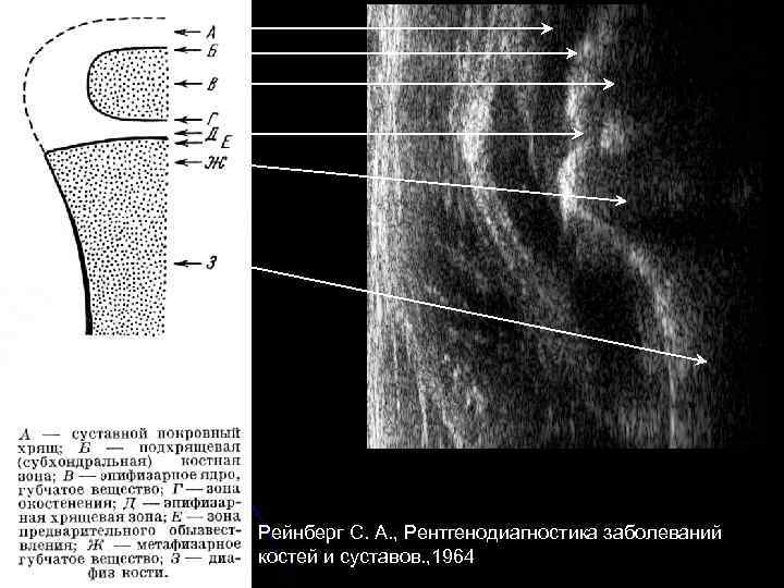 Рейнберг С. А. , Рентгенодиагностика заболеваний костей и суставов. , 1964 