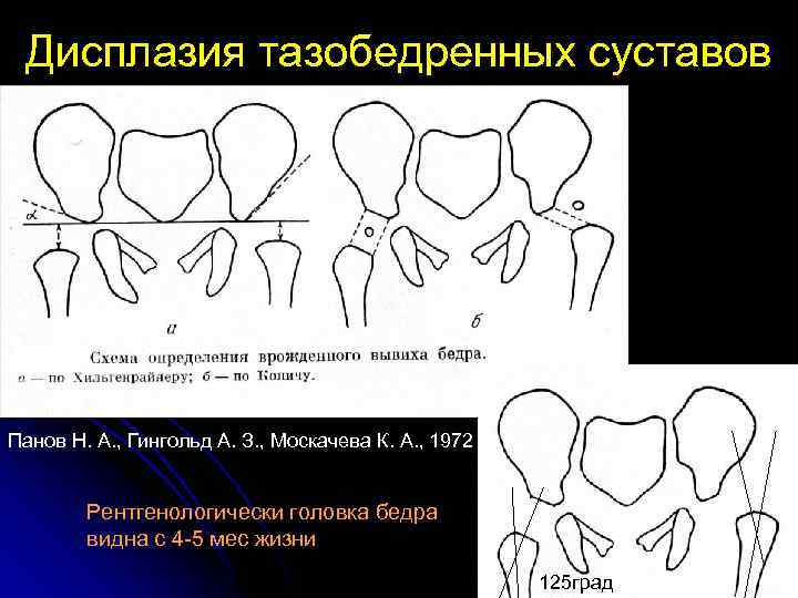 Схема врожденного вывиха бедра