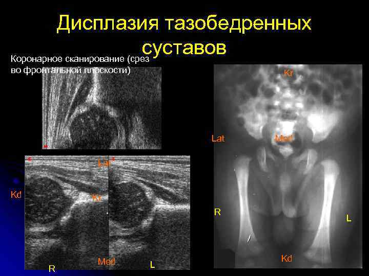 Дисплазия тазобедренных суставов Коронарное сканирование (срез во фронтальной плоскости) Kr Lat Med Lat Kd