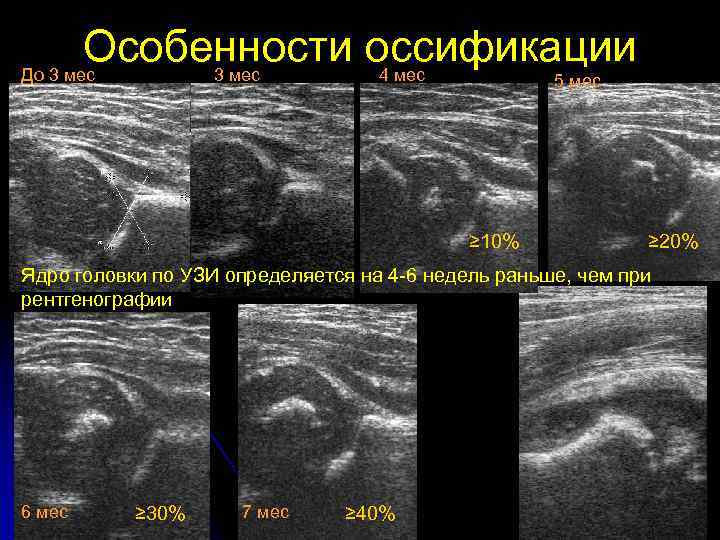 Особенности оссификации До 3 мес 4 мес 5 мес ≥ 10% ≥ 20% Ядро