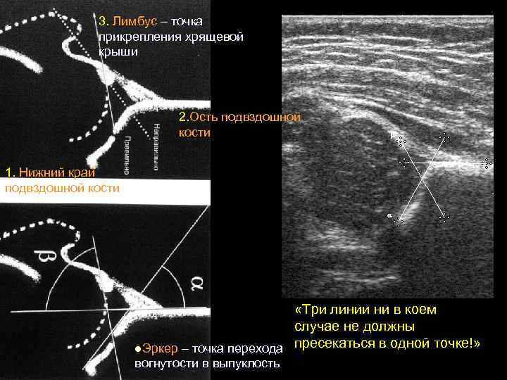 3. Лимбус – точка прикрепления хрящевой крыши 2. Ость подвздошной кости 1. Нижний край