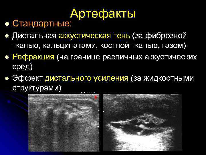 Артефакты l Стандартные: l Дистальная аккустическая тень (за фиброзной тканью, кальцинатами, костной тканью, газом)