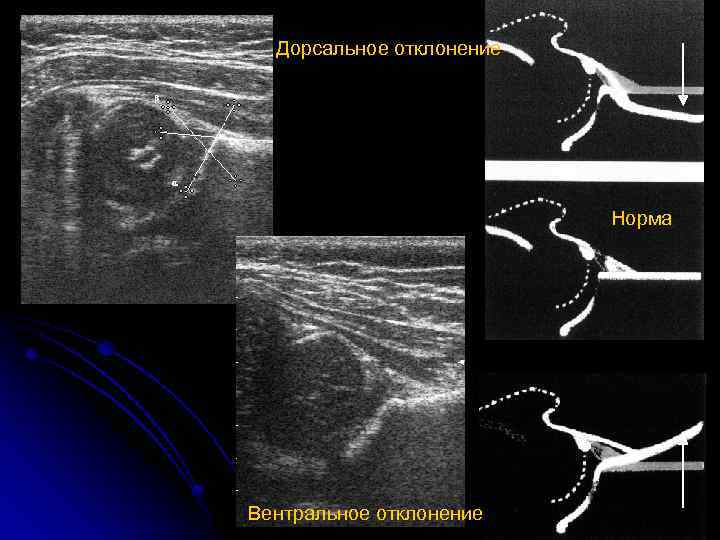 Дорсальное отклонение Норма Вентральное отклонение 