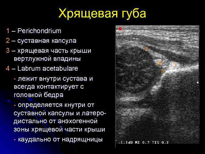 Хрящевая губа 1 – Perichondrium 2 – суставная капсула 3 – хрящевая часть крыши