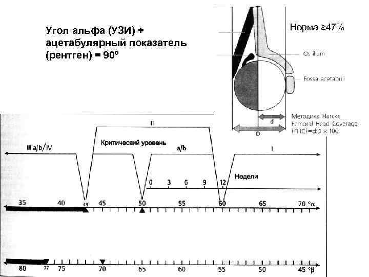 Угол альфа (УЗИ) + ацетабулярный показатель (рентген) = 90º Норма ≥ 47% 