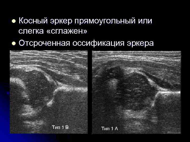 Косный эркер прямоугольный или слегка «сглажен» l Отсроченная оссификация эркера l Тип 1 В