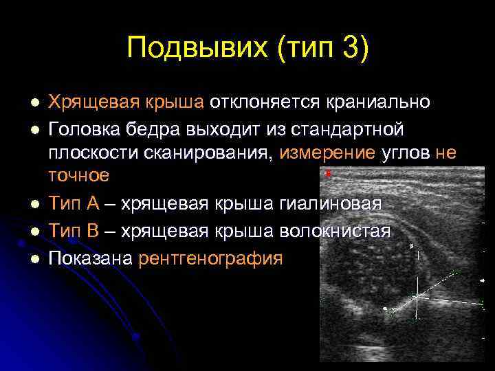 Подвывих (тип 3) l l l Хрящевая крыша отклоняется краниально Головка бедра выходит из
