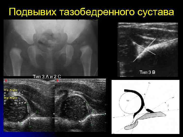 Подвывих тазобедренного сустава Тип 3 А и 2 С Тип 3 В 