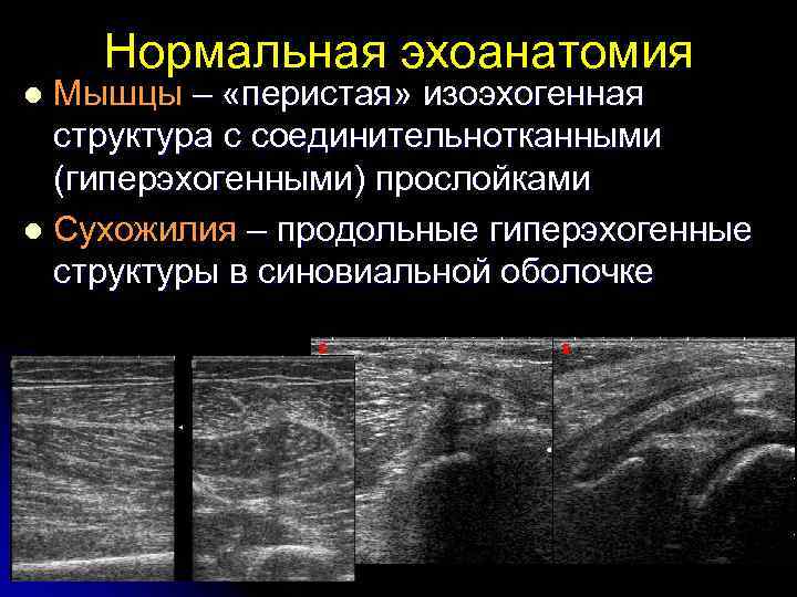 Нормальная эхоанатомия Мышцы – «перистая» изоэхогенная структура с соединительнотканными (гиперэхогенными) прослойками l Сухожилия –