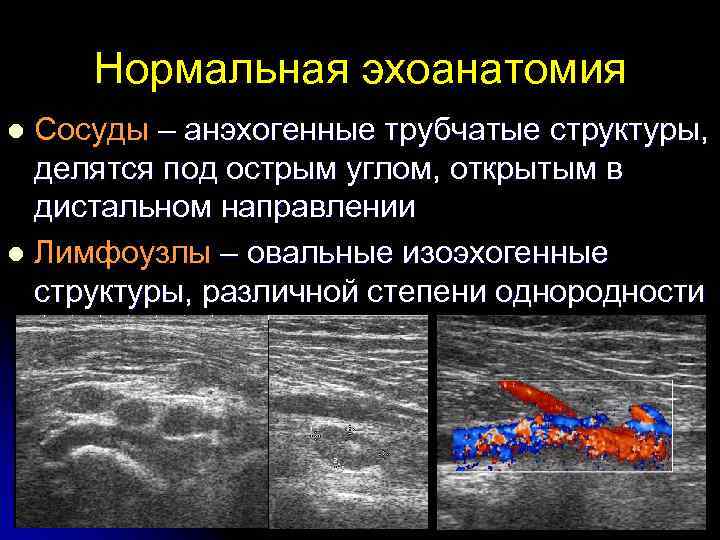Нормальная эхоанатомия Сосуды – анэхогенные трубчатые структуры, делятся под острым углом, открытым в дистальном