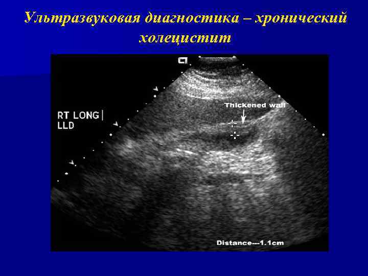 Ультразвуковая диагностика – хронический холецистит 