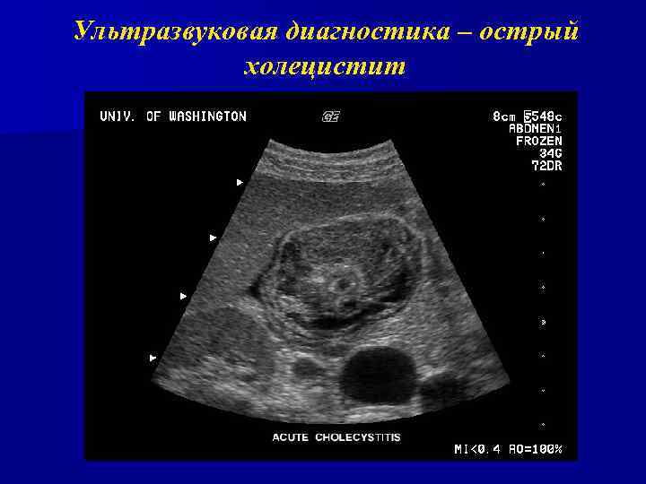 Ультразвуковая диагностика – острый холецистит 