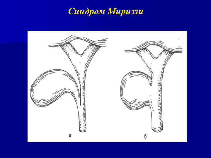 Синдром мириззи презентация