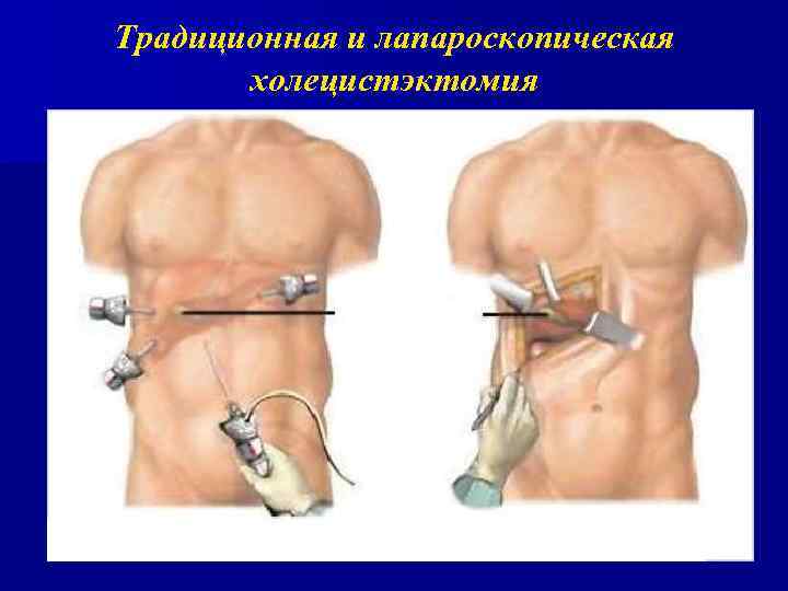 Традиционная и лапароскопическая холецистэктомия 