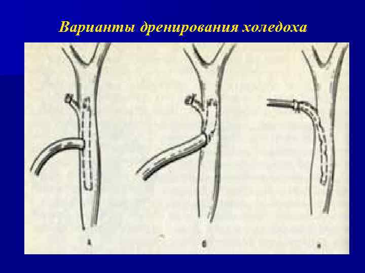 Сегменты холедоха схема