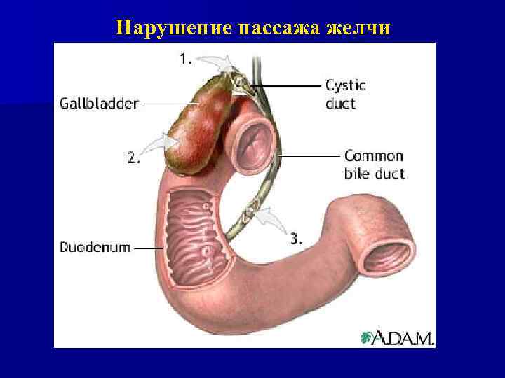 Нарушение пассажа желчи 