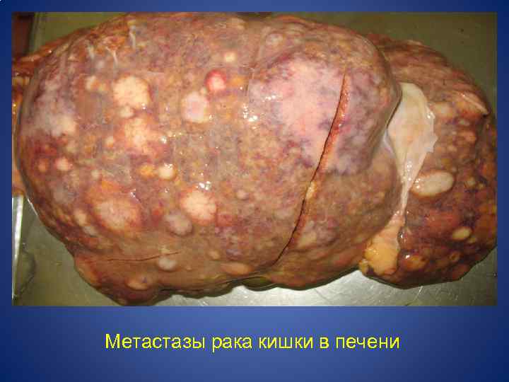 Метастазы рака кишки в печени 
