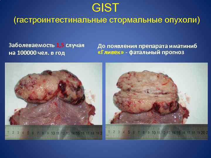 GIST (гастроинтестинальные стормальные опухоли) Заболеваемость 1, 5 случая на 100000 чел. в год До