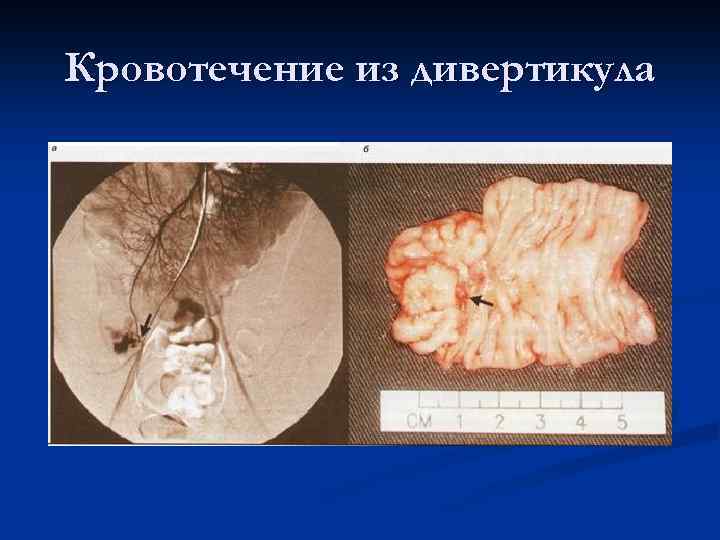 Кровотечение из дивертикула 