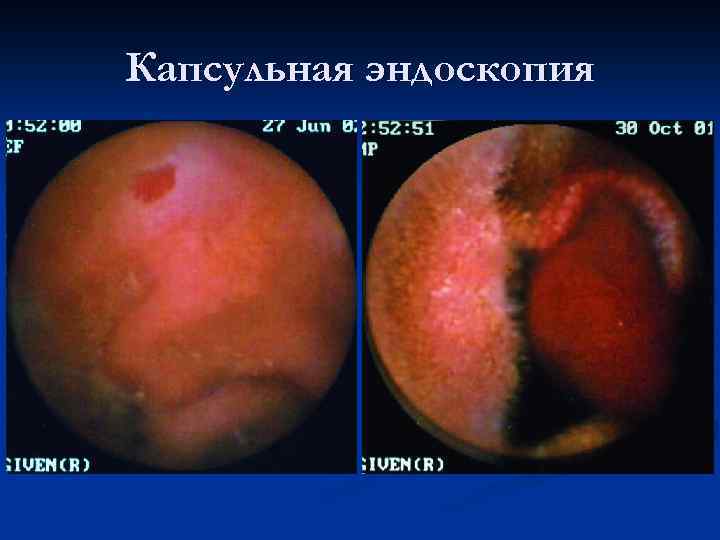 Капсульная эндоскопия 