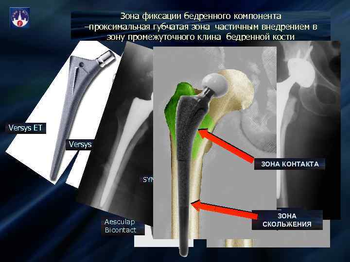 Зона фиксации бедренного компонента –проксимальная губчатая зона частичным внедрением в зону промежуточного клина бедренной