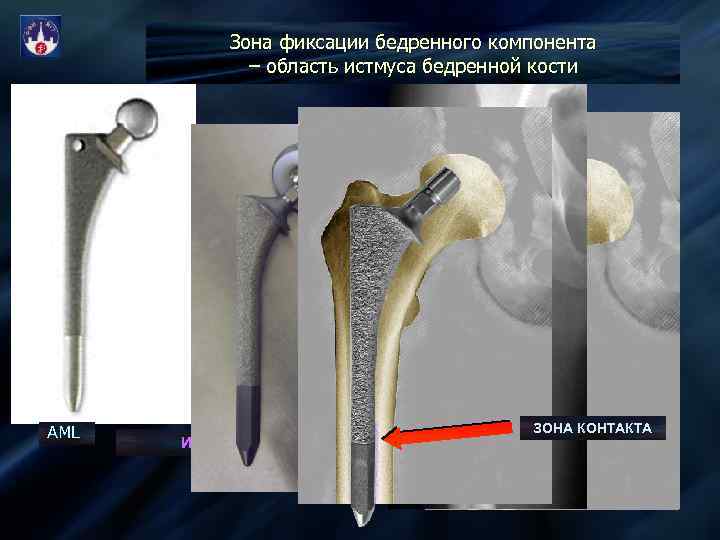 Зона фиксации бедренного компонента – область истмуса бедренной кости AML ЗОНА КОНТАКТА ИСТМУС ЭЛИТ