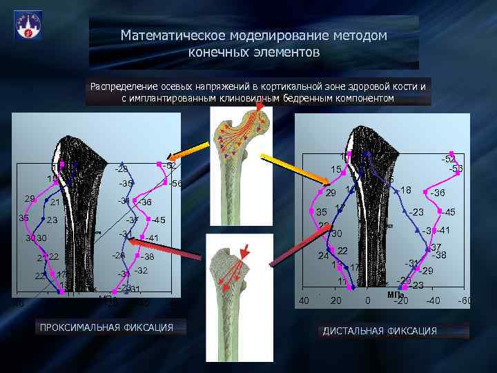 Математическое моделирование методом конечных элементов Распределение осевых напряжений в кортикальной зоне здоровой кости и