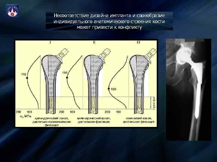 Несоответствие дизайна импланта и своеобразие индивидуального анатомического строения кости может привести к конфликту 