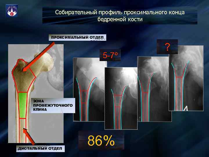 Проксимальный отдел кости. Проксимальный отдел бедренной кости. Проксимальный и дистальный отдел. Проксимальный и дистальный отдел бедренной кости. Проксимальный отдел и дистальный отдел.