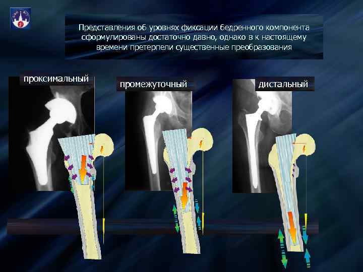 Представления об уровнях фиксации бедренного компонента сформулированы достаточно давно, однако в к настоящему времени