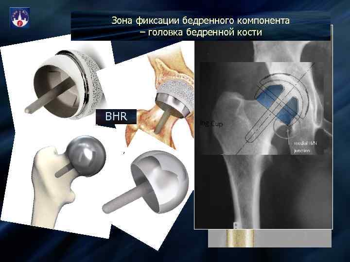 Суставные головки костей. Титановая головка на бедренную кость. Крепление протеза к кости. Компонент бедренный.