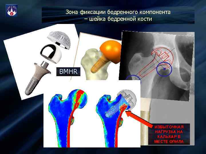 Зона фиксации бедренного компонента – шейка бедренной кости ШЕЙКА BMHR ИЗБЫТОЧНАЯ НАГРУЗКА НА КАЛЬКАР