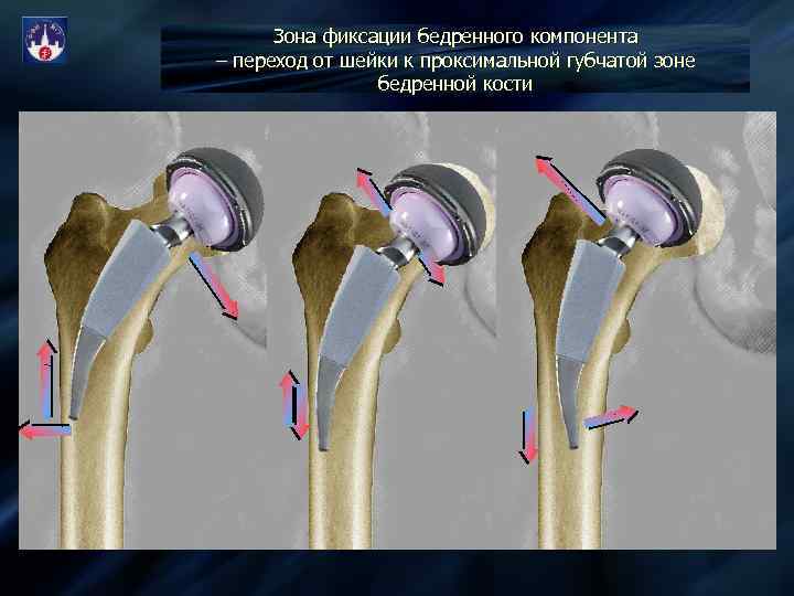 Поменять шейку бедра. Тотальный бесцементный эндопротез тазобедренного сустава. Эндопротез тазобедренного сустава рентген протокол. Двухэтапное ревизионное эндопротезирование тазобедренного сустава.