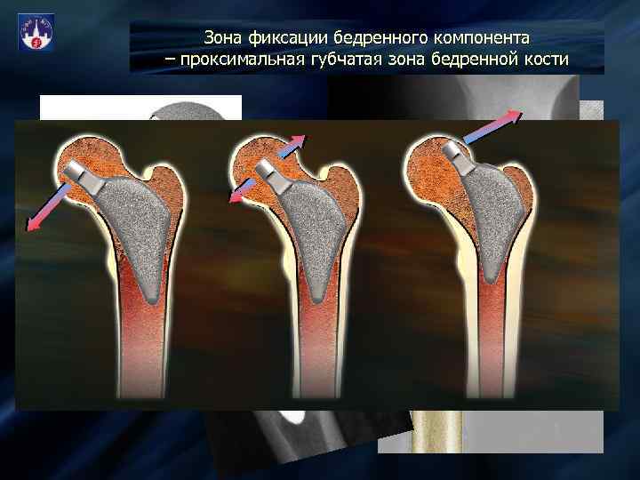 Зона фиксации бедренного компонента – проксимальная губчатая зона бедренной кости ПРОКСИМАЛЬНАЯ ГУБЧАТАЯ ЗОНА De.