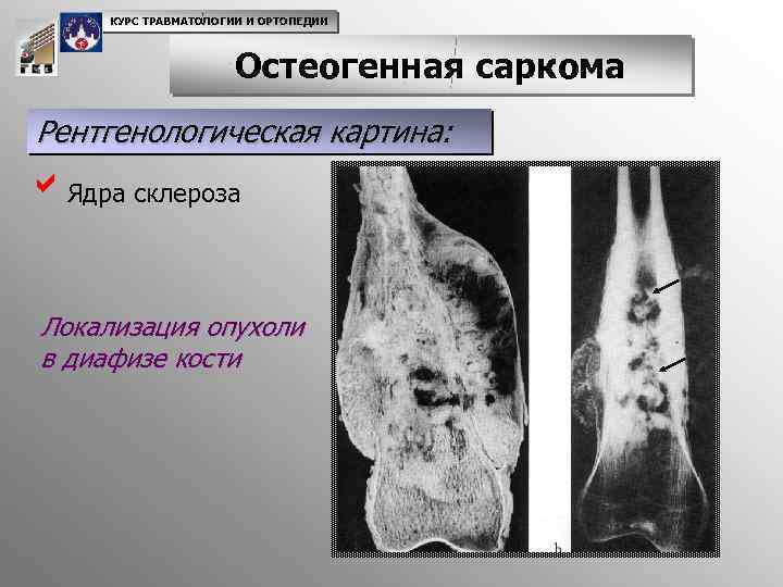 КУРС ТРАВМАТОЛОГИИ И ОРТОПЕДИИ Остеогенная саркома Рентгенологическая картина: a. Ядра склероза Локализация опухоли в