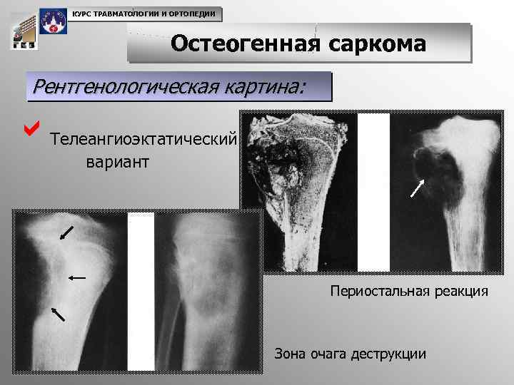 КУРС ТРАВМАТОЛОГИИ И ОРТОПЕДИИ Остеогенная саркома Рентгенологическая картина: a. Телеангиоэктатический вариант Периостальная реакция Зона