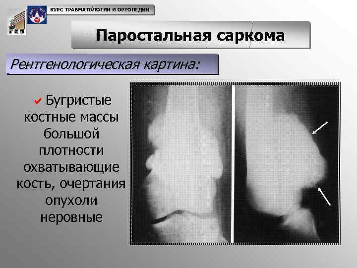 КУРС ТРАВМАТОЛОГИИ И ОРТОПЕДИИ Паростальная саркома Рентгенологическая картина: a. Бугристые костные массы большой плотности