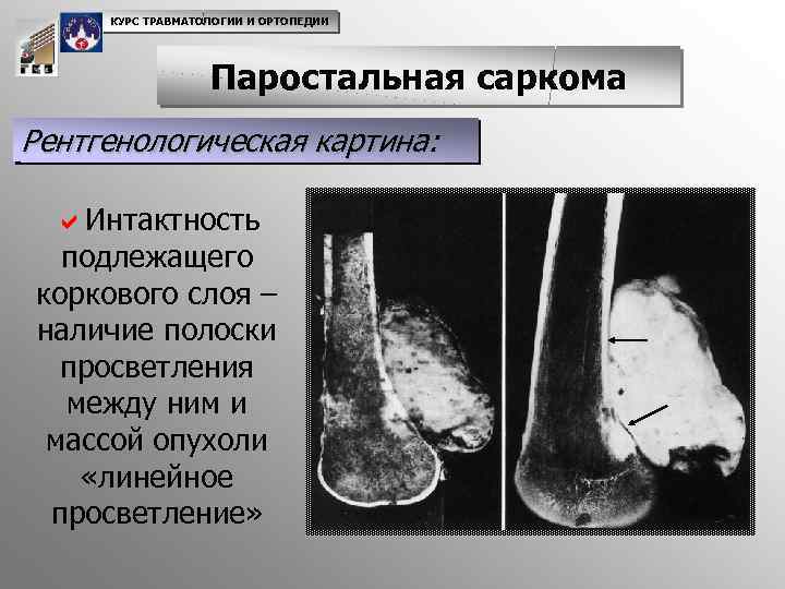 КУРС ТРАВМАТОЛОГИИ И ОРТОПЕДИИ Паростальная саркома Рентгенологическая картина: a. Интактность подлежащего коркового слоя –